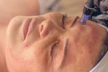 Microneedling Treatments in Las Vegas, NV