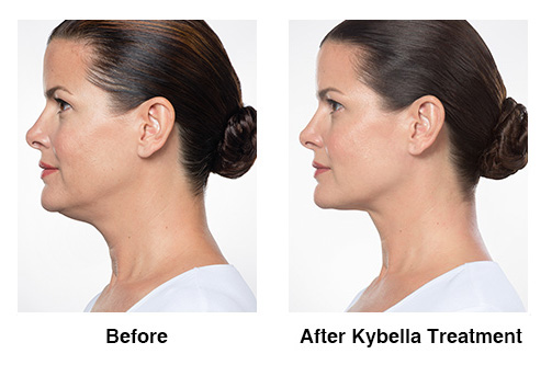 Kybella Before and After