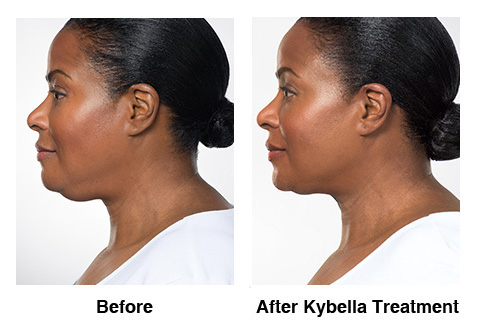 Kybella Before and After