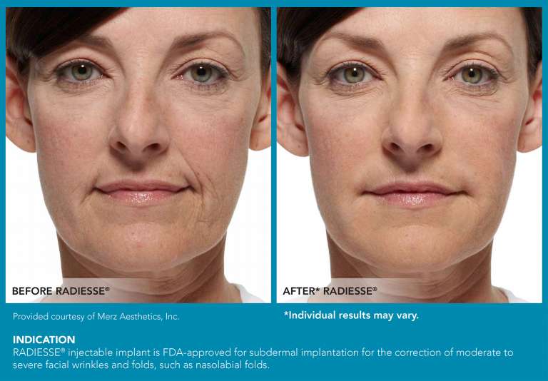 Restylane Radiesse Belotero Juvederm Dermal Fillers Las Vegas NV